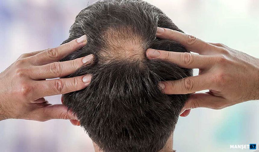 Ankara Saç Ekimi Operasyonlarına Dair Bilmeniz Gerekenler