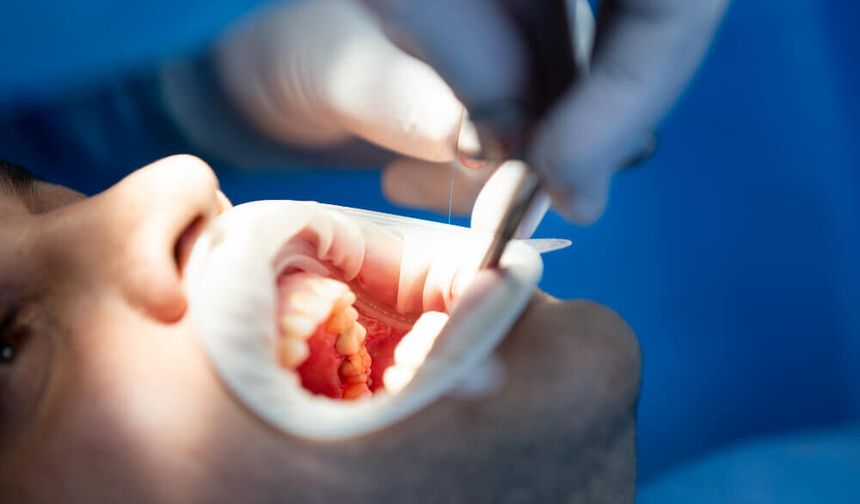 Diş Taşı Temizliği: Sağlıklı Bir Gülüşün İlk Adımı